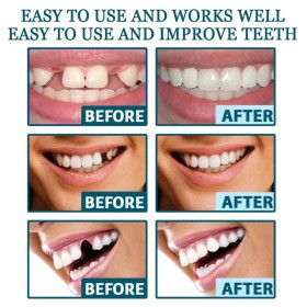 التركيبة القابلة للتركيب الفوري –Adjustable Snap On Dentures