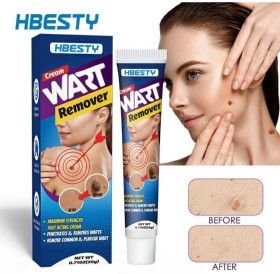 تخلص من الثآليل بسرعة وفعالية مع كريم HBESTY