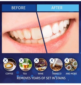 شرائط تبييض الأسنان Magic Brite 5D